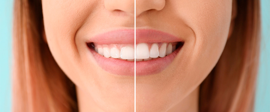 Estética dental